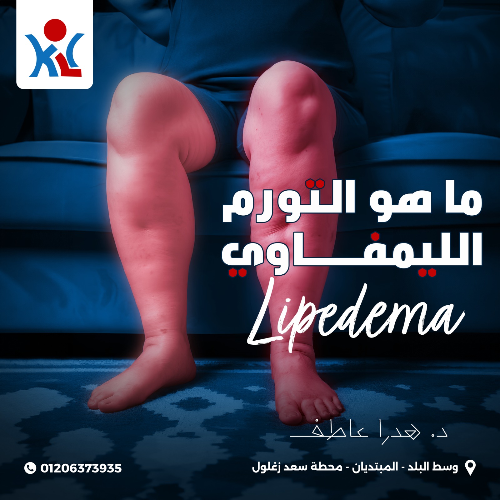 مركز الكرمه لعلاج مرض الفيل
