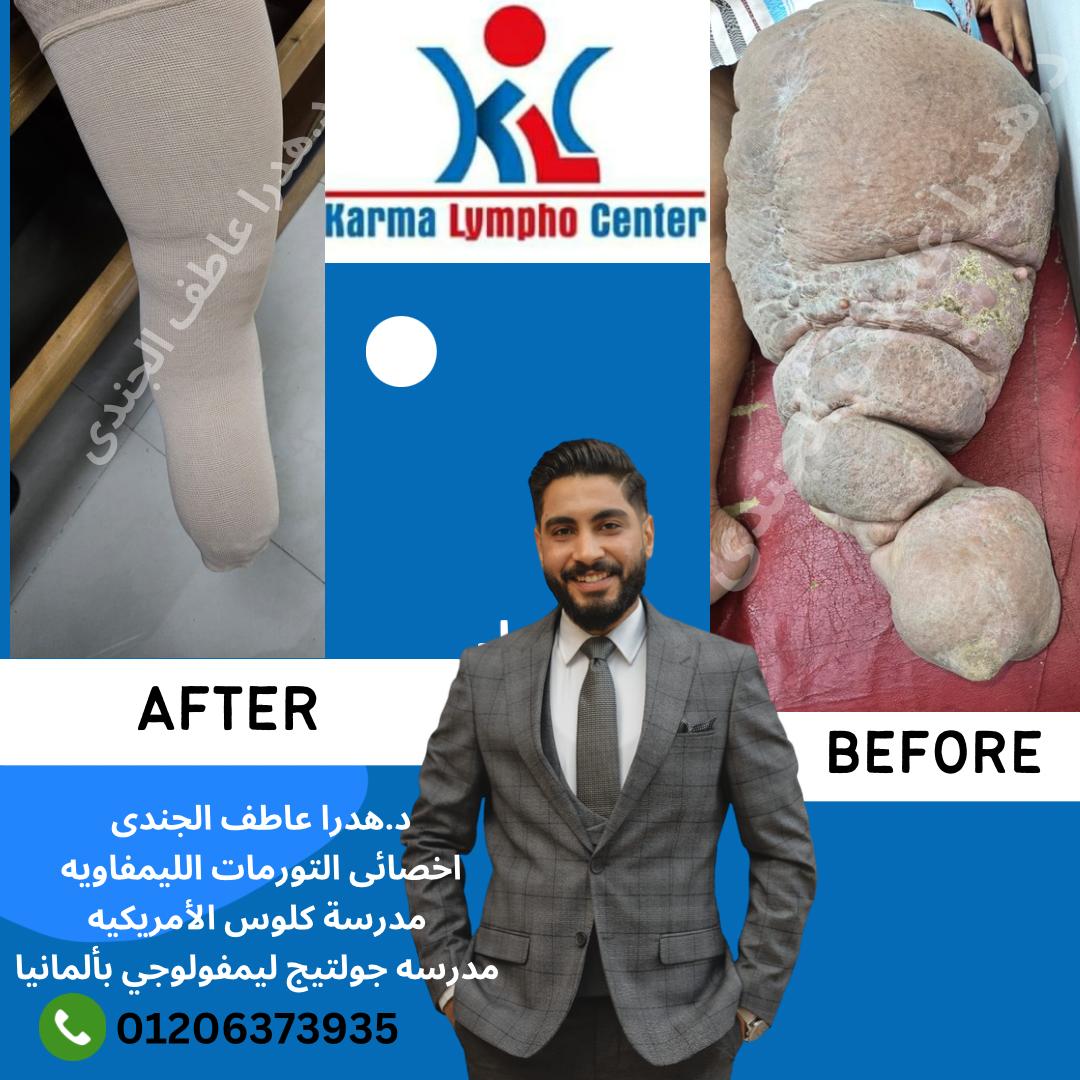 مركز الكرمه لعلاج مرض الفيل