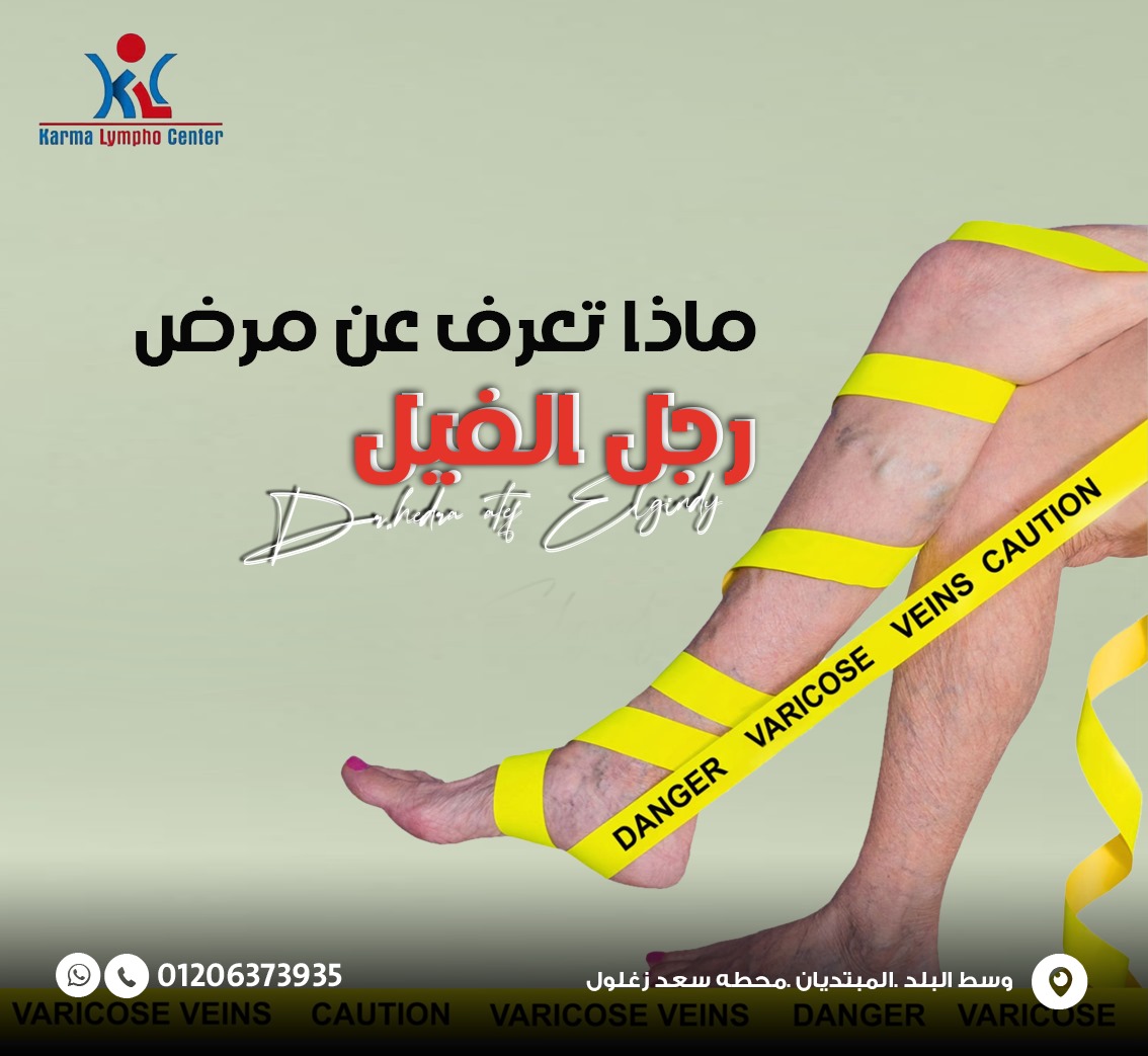 مركز الكرمه لعلاج مرض الفيل
