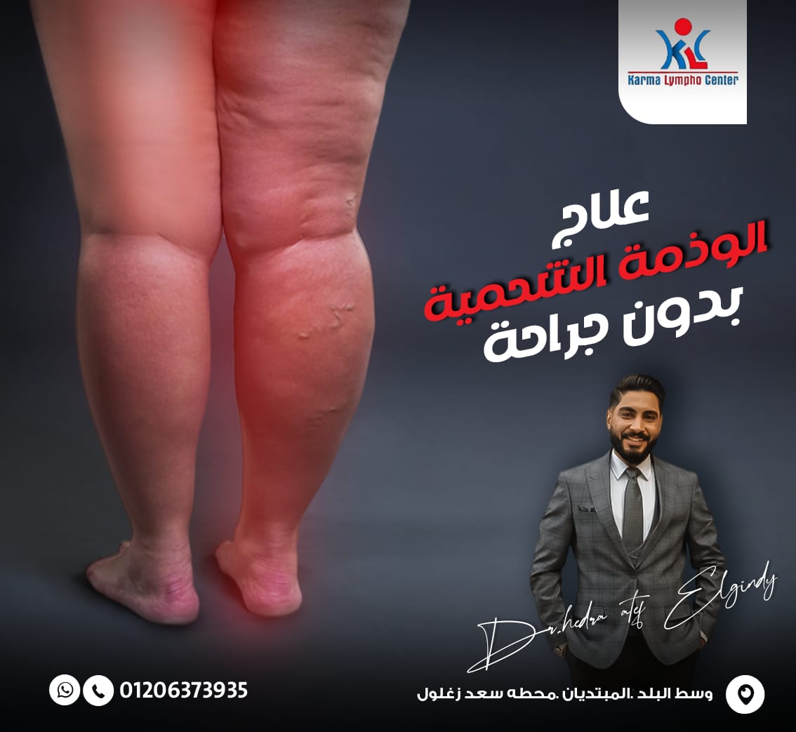 مركز الكرمه لعلاج مرض الفيل