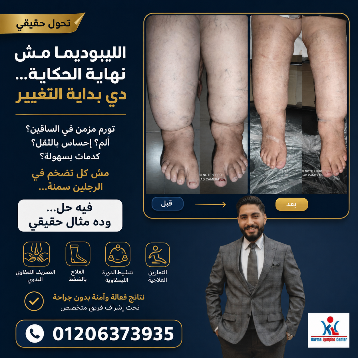 مركز الكرمه لعلاج مرض الفيل