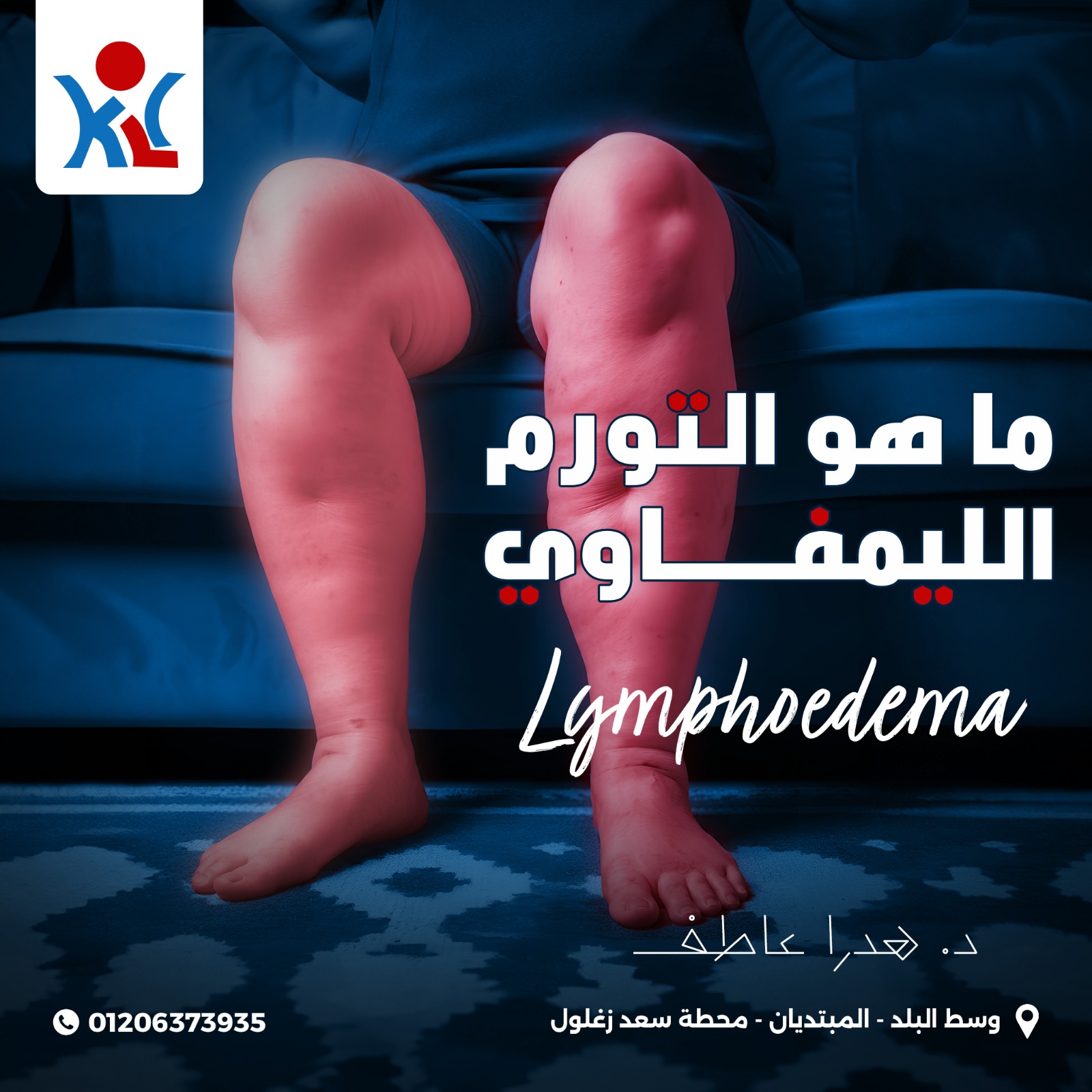 مركز الكرمه لعلاج مرض الفيل