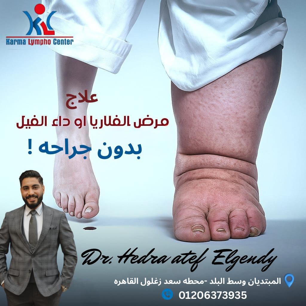 مركز الكرمه لعلاج مرض الفيل
